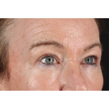 Blepharoplasty (Eyelid Surgery) Before & After Patient #11404
