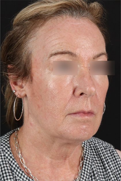 CO2 Laser Before & After Patient #11385