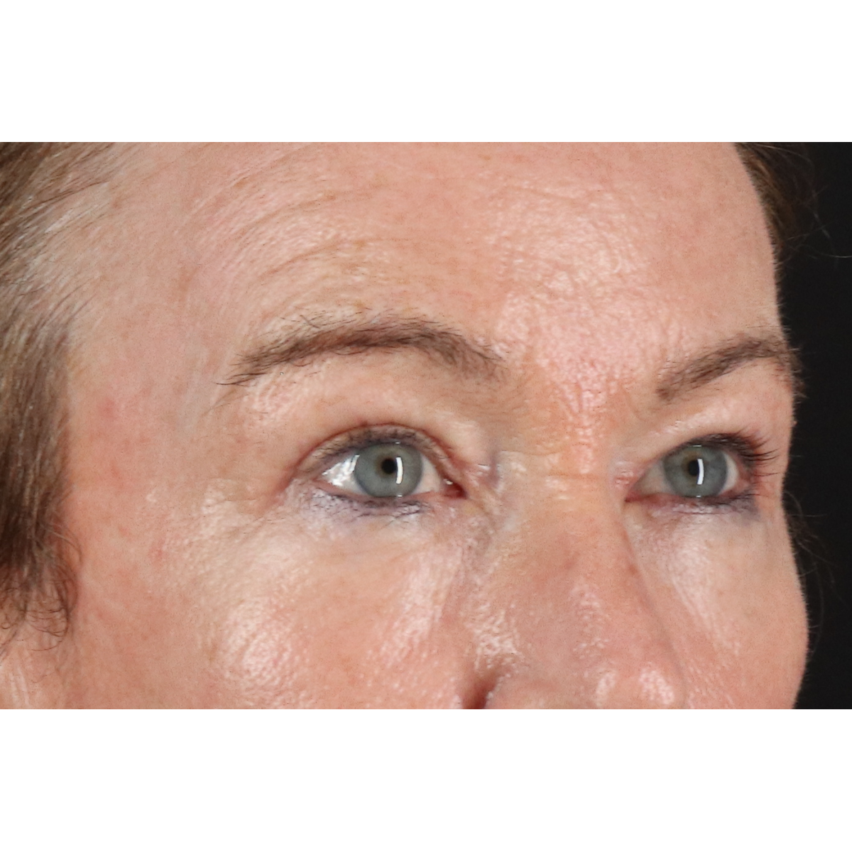 Blepharoplasty (Eyelid Surgery) Before & After Patient #11404