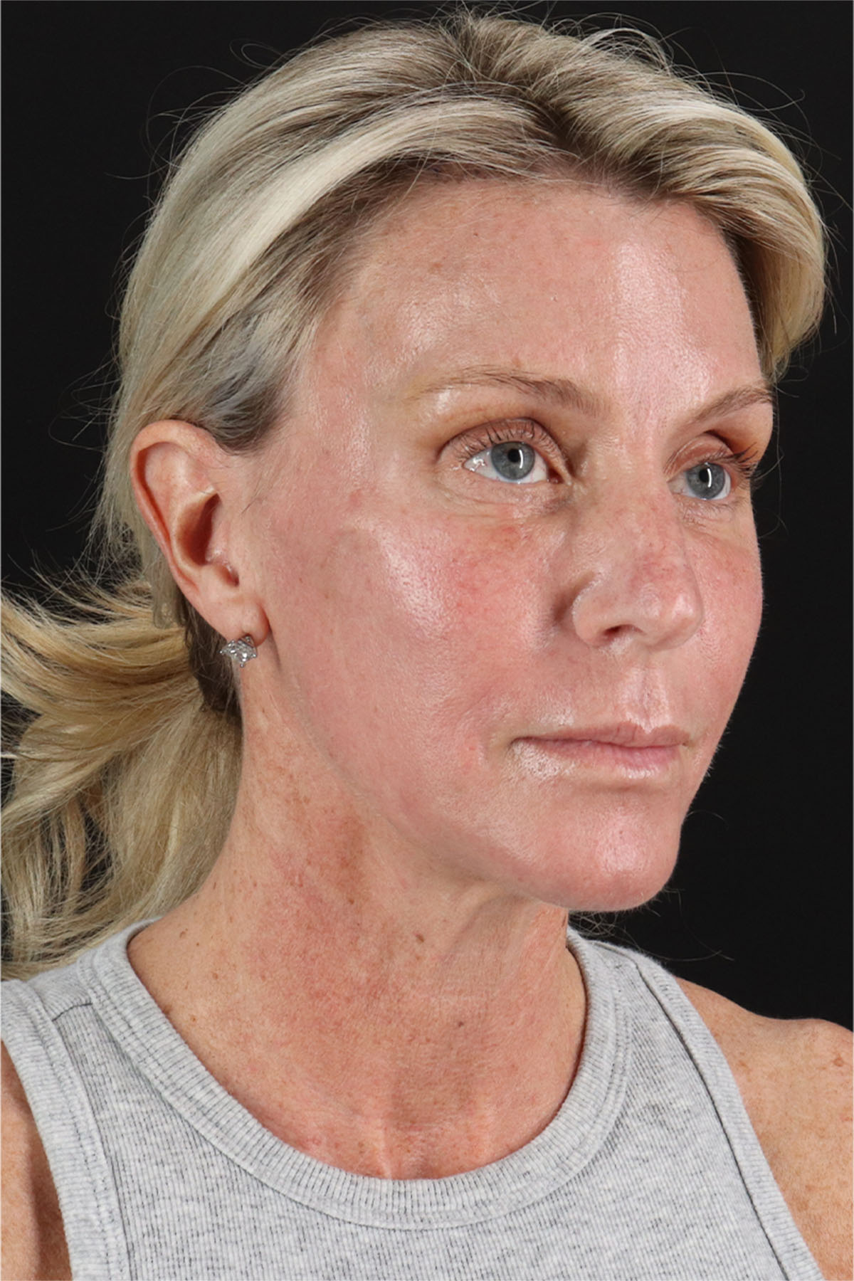 Facelift Before & After Patient #11682