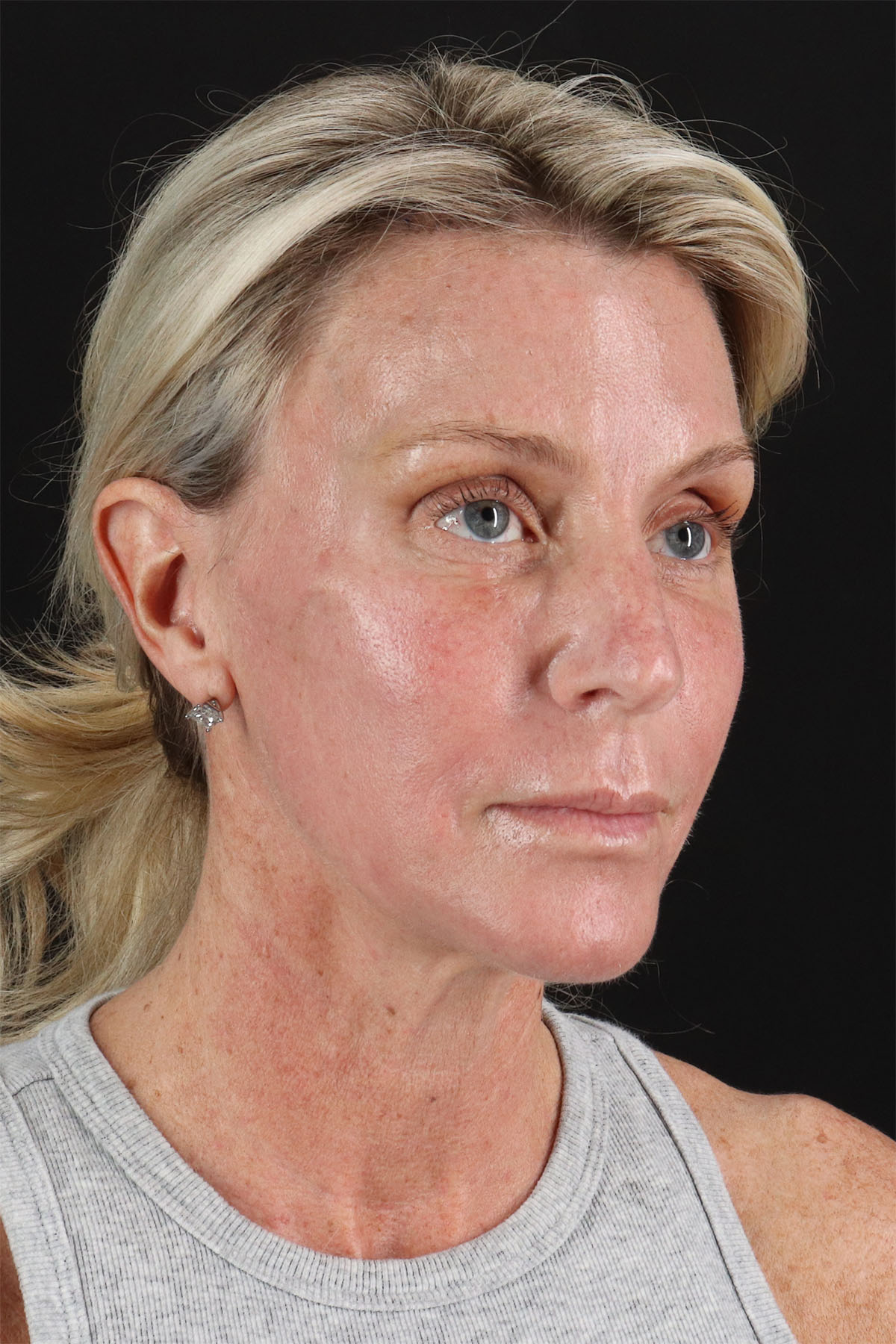 CO2 Laser Before & After Patient #11202
