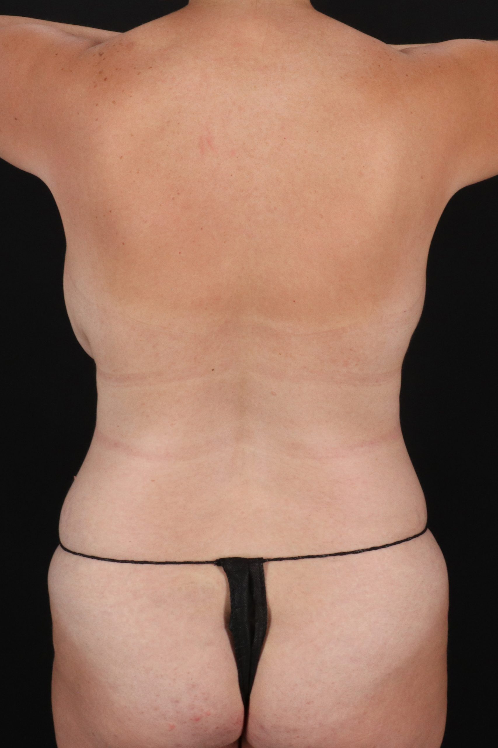 All Me Augmentation Before & After Patient #10274