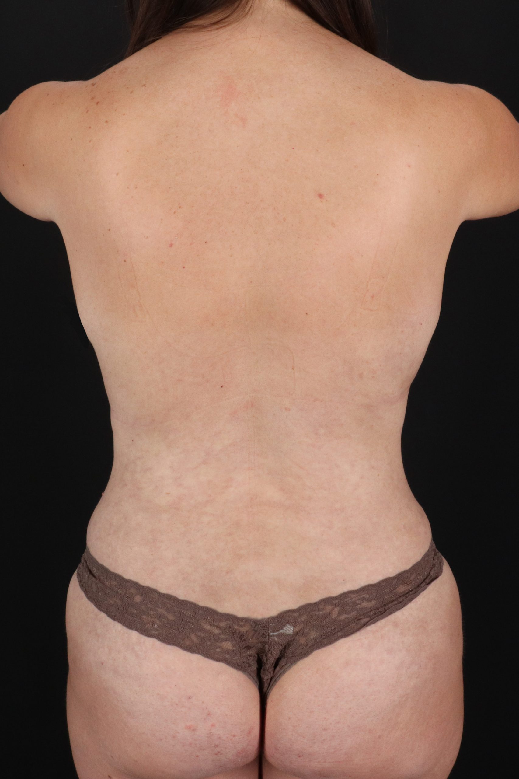 All Me Augmentation Before & After Patient #10274