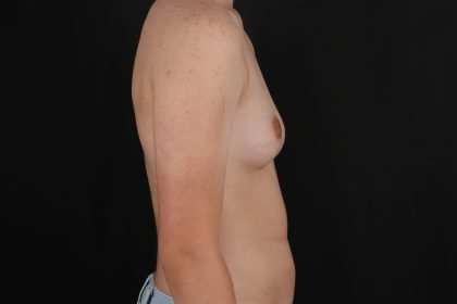 Female To Male Breast Before & After Patient #9981