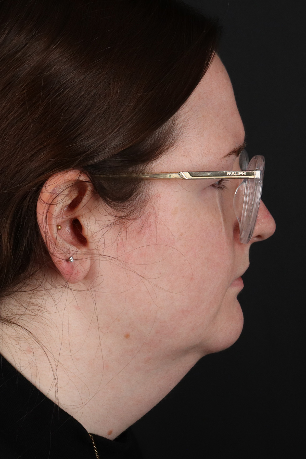 Quantum RF Before & After Patient #9983
