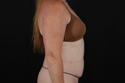 Abdominoplasty (Tummy Tuck) Before & After Patient #9980