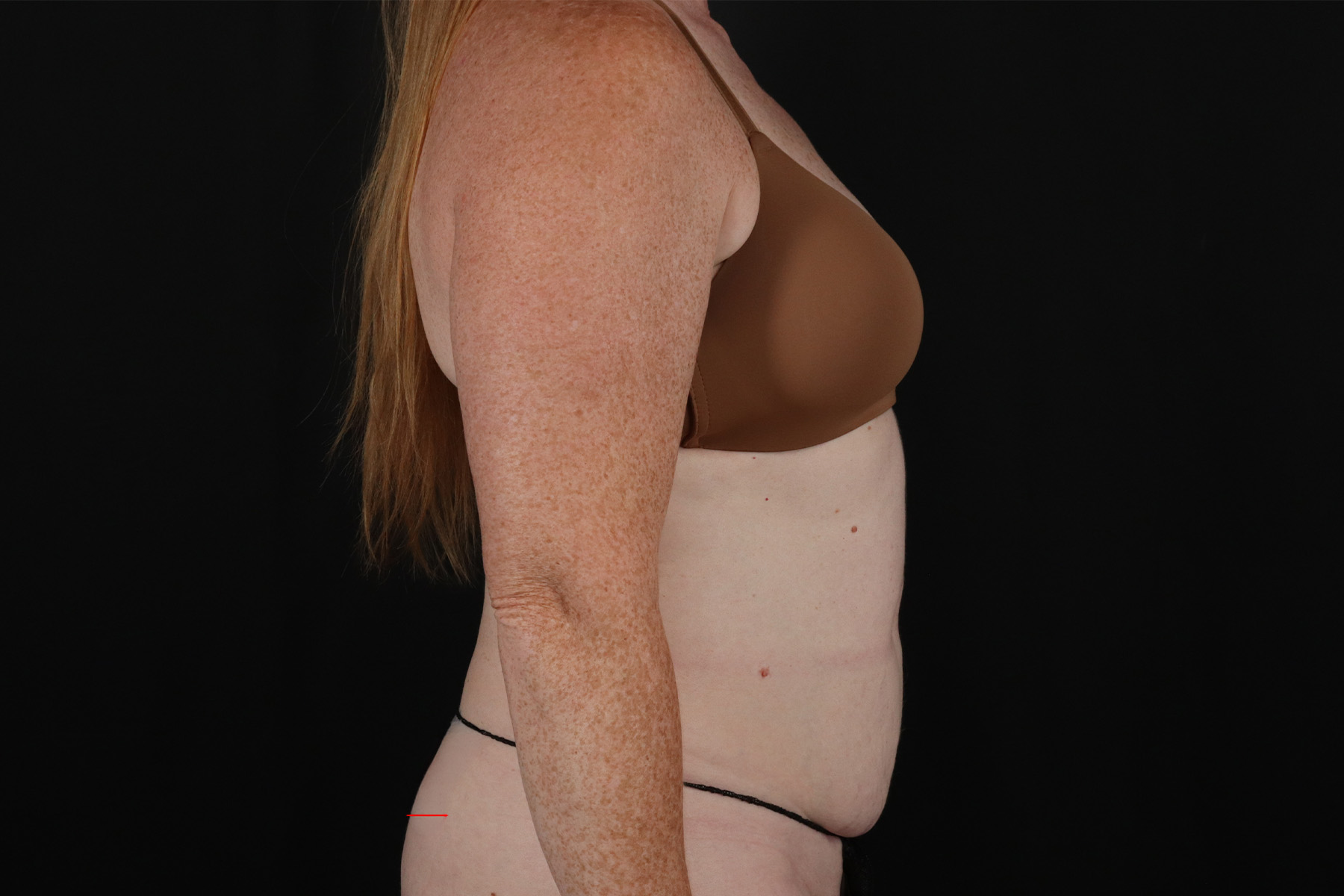 Abdominoplasty (Tummy Tuck) Before & After Patient #9980