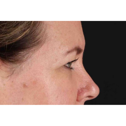 Brow Lift Before & After Patient #10859