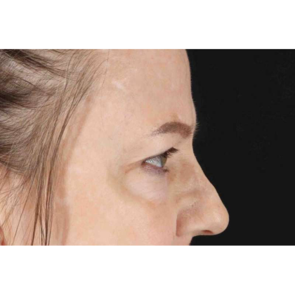 Brow Lift Before & After Patient #10848