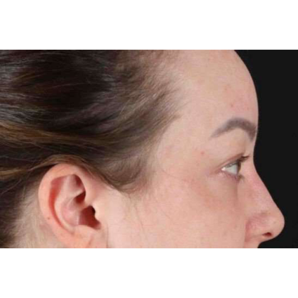 Brow Lift Before & After Patient #10837