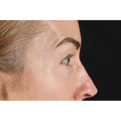 CO2 Laser Before & After Patient #10551