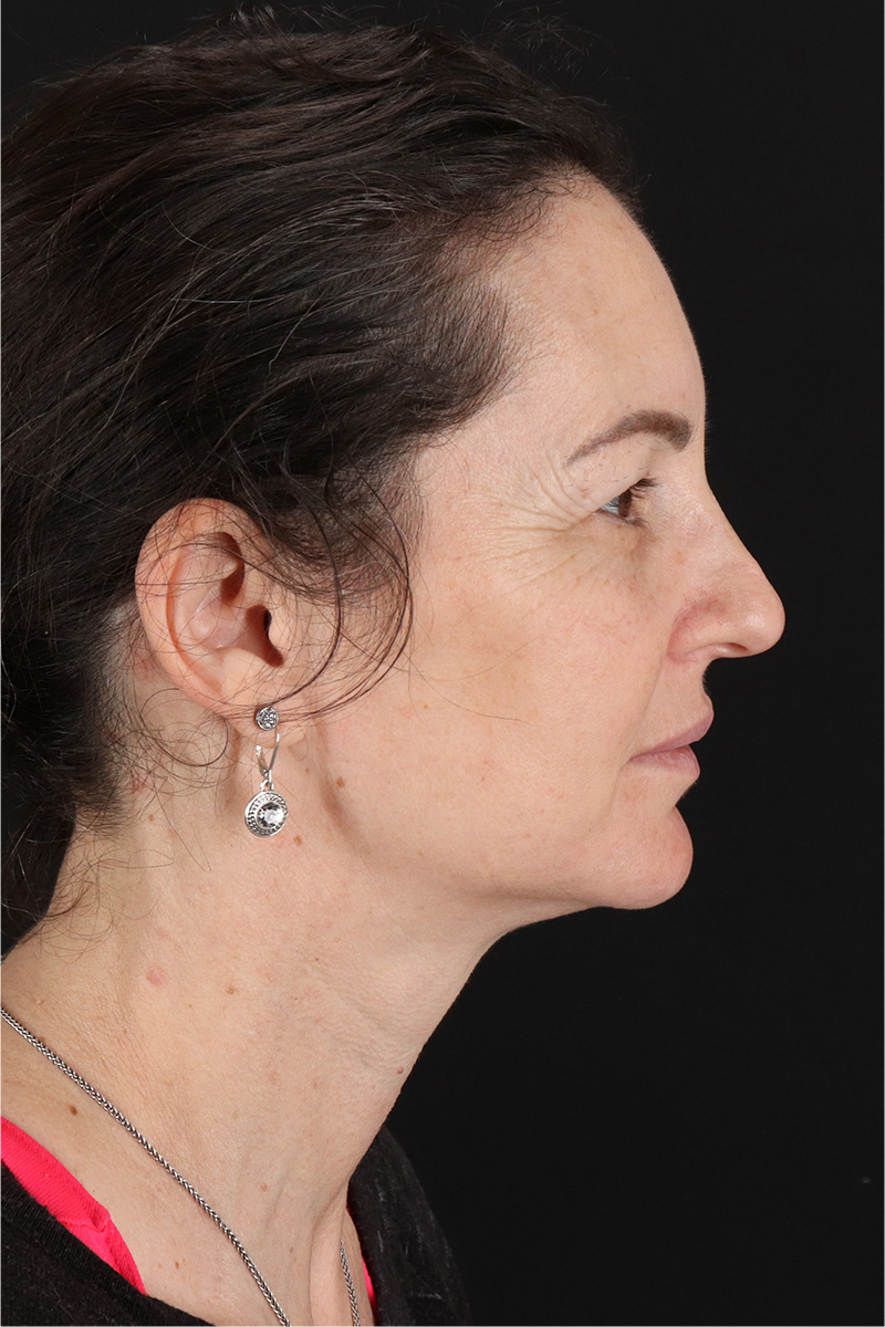 Chemical Peels Before & After Patient #11418