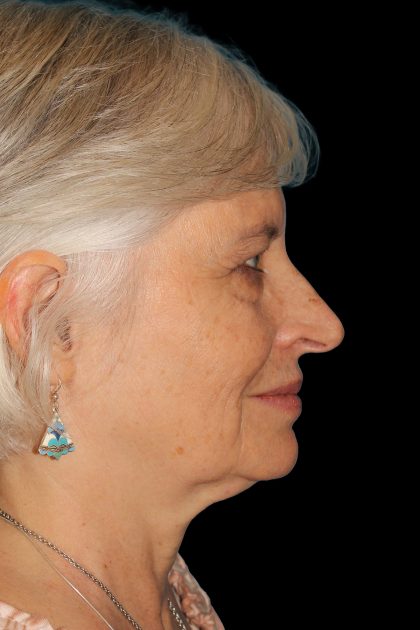 Lower Blepharoplasty Before & After Patient #12997