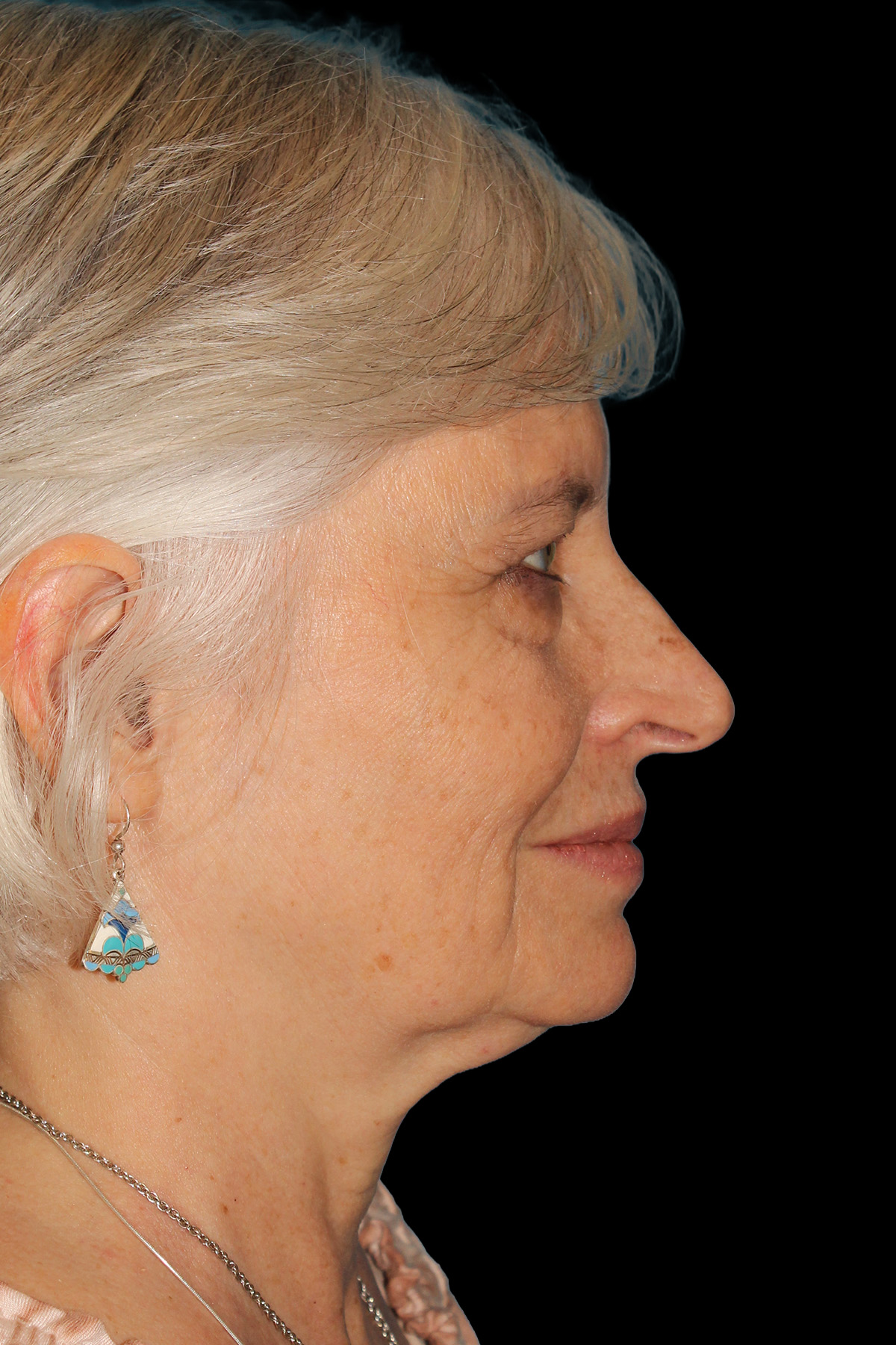 Upper Blepharoplasty Before & After Patient #11996