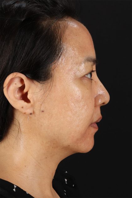 CO2 Laser Before & After Patient #11059