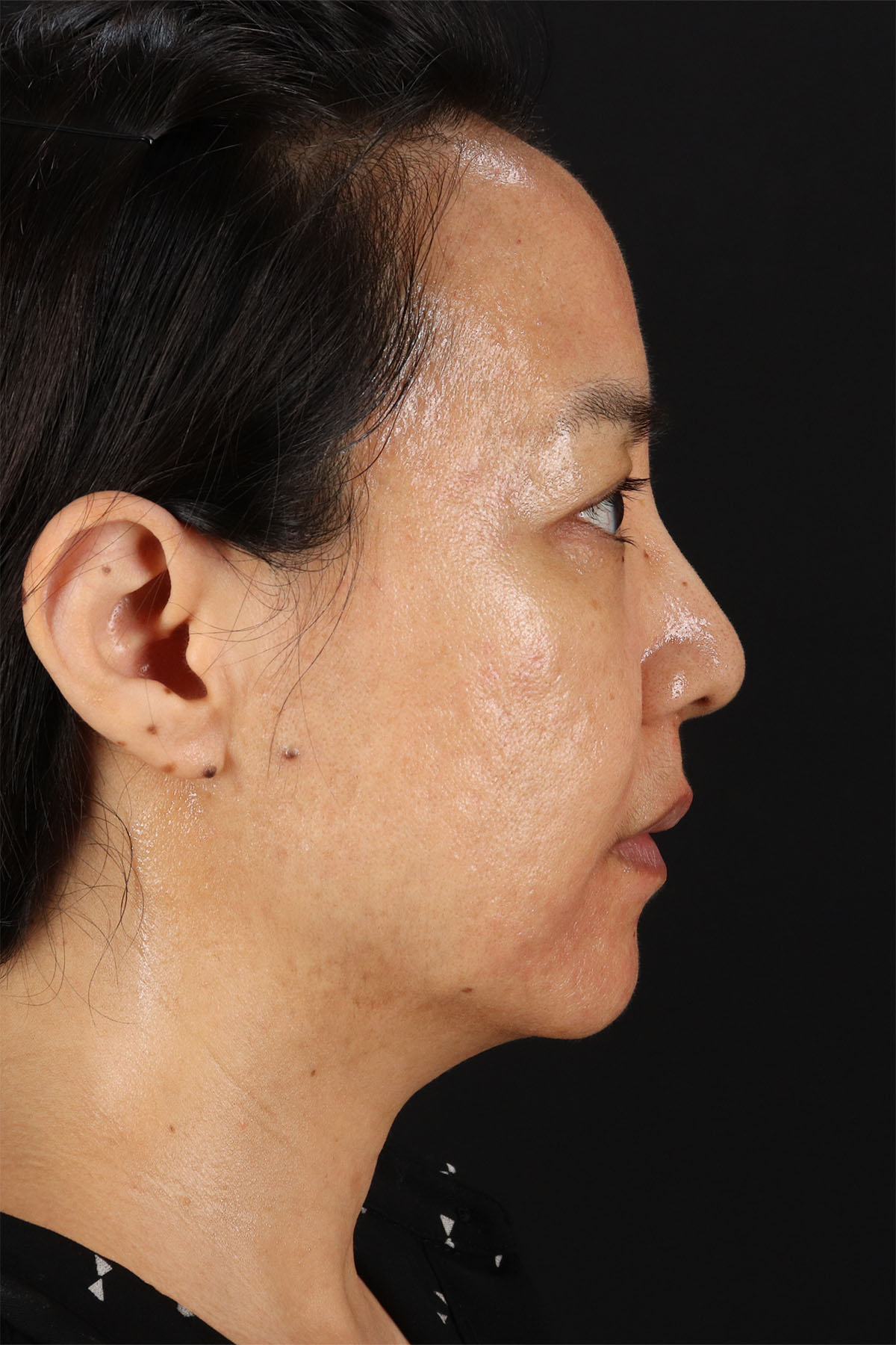 CO2 Laser Before & After Patient #11059