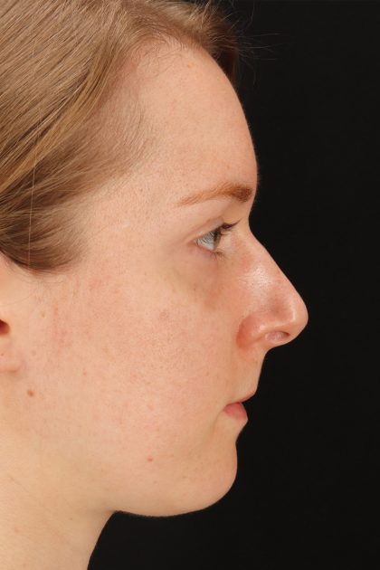 Rhinoplasty Before & After Patient #12238