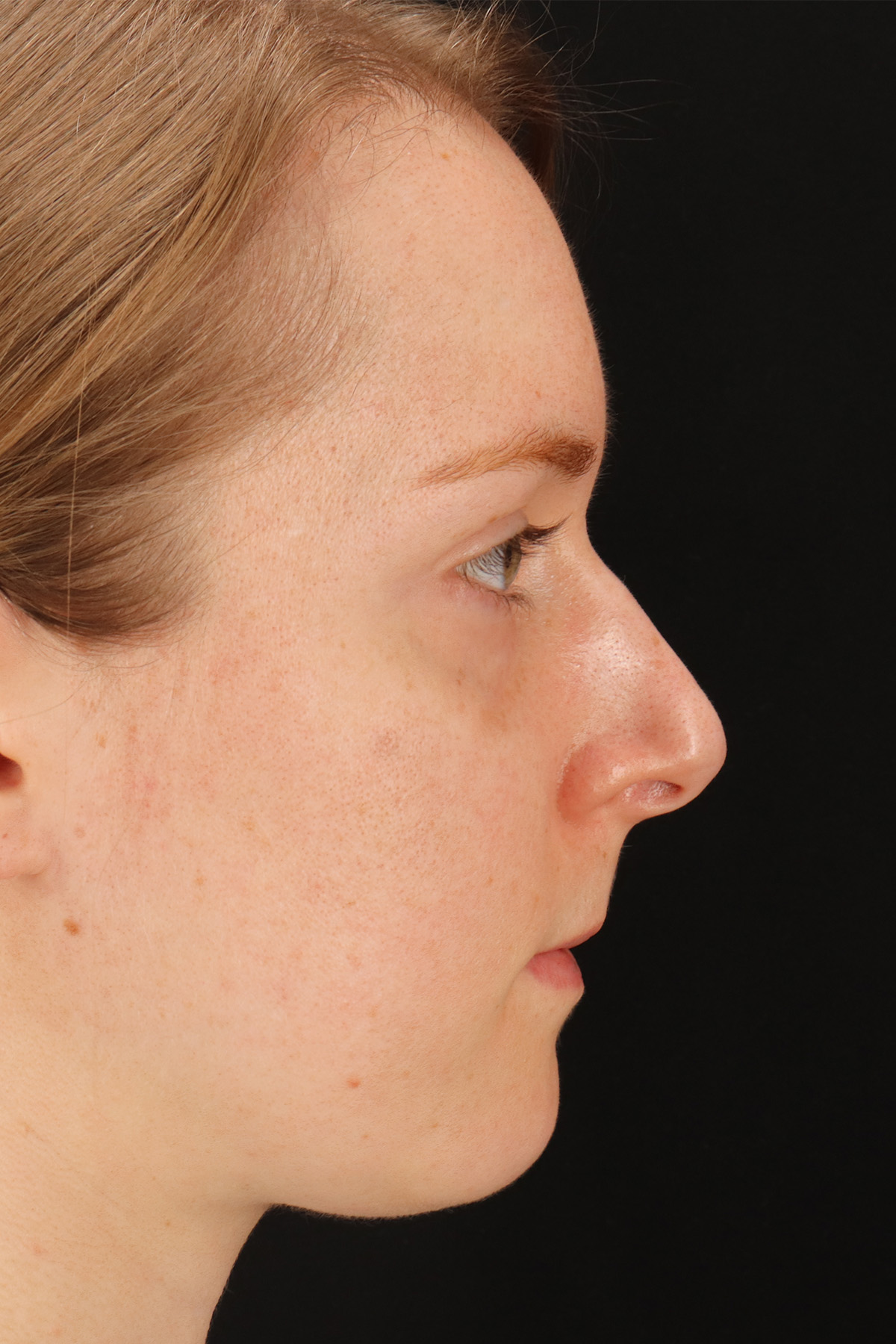 Rhinoplasty Before & After Patient #12238