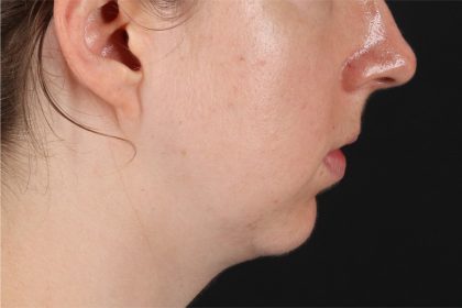 Chin Implant Before & After Patient #13761