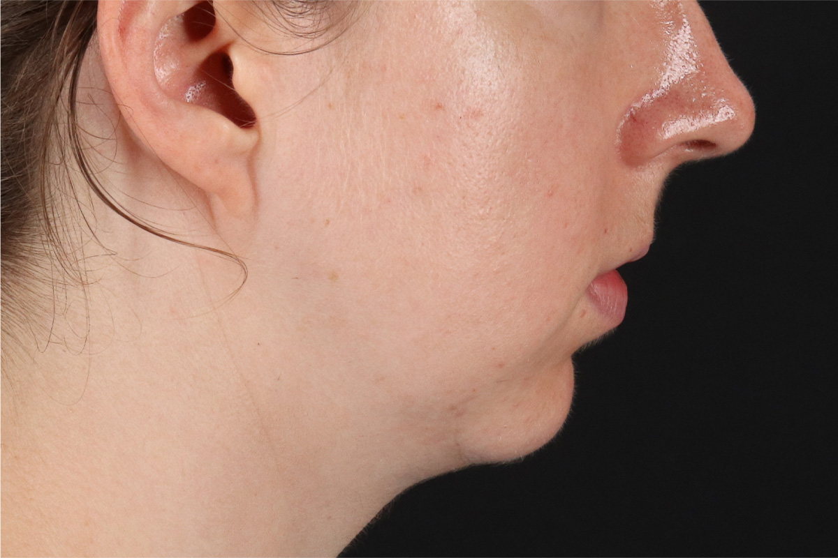 Chin Implant Before & After Patient #13761