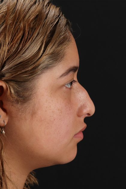 Rhinoplasty Before & After Patient #12491