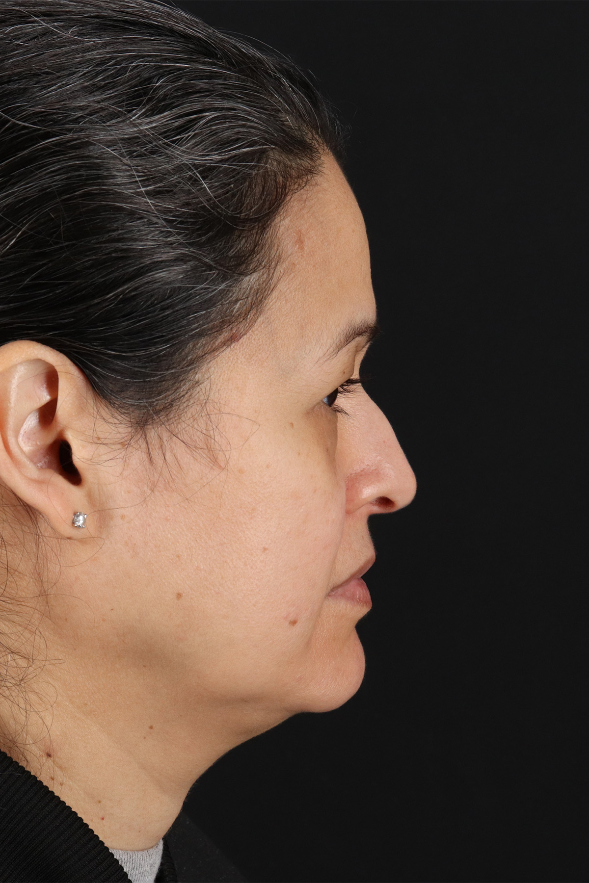 Rhinoplasty Before & After Patient #12205