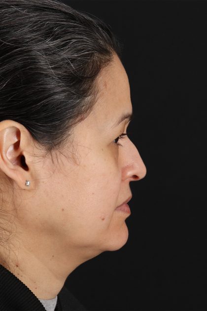 Lower Blepharoplasty Before & After Patient #13019