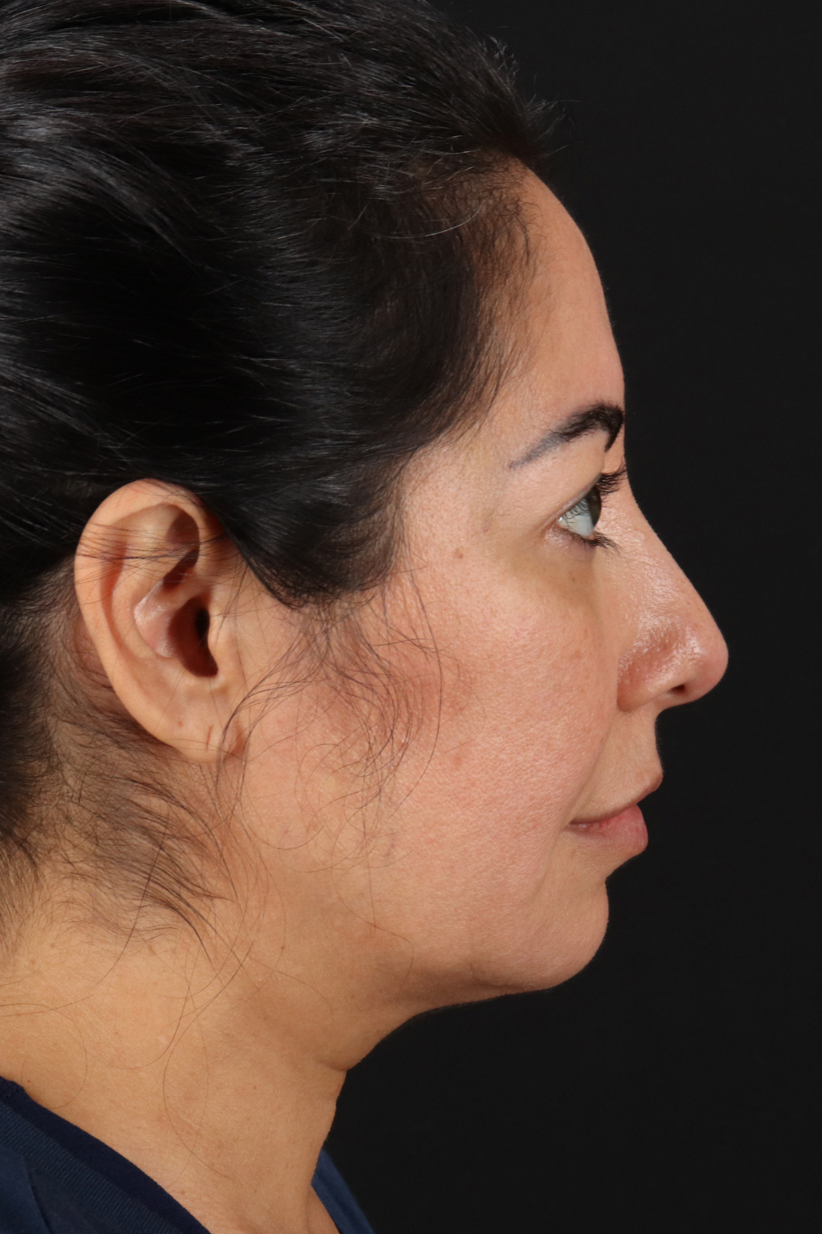 Buccal Fat Pad Before & After Patient #14014
