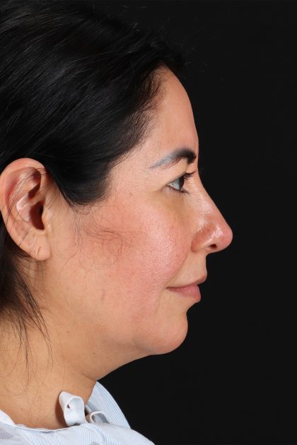 Upper Blepharoplasty Before & After Patient #12062