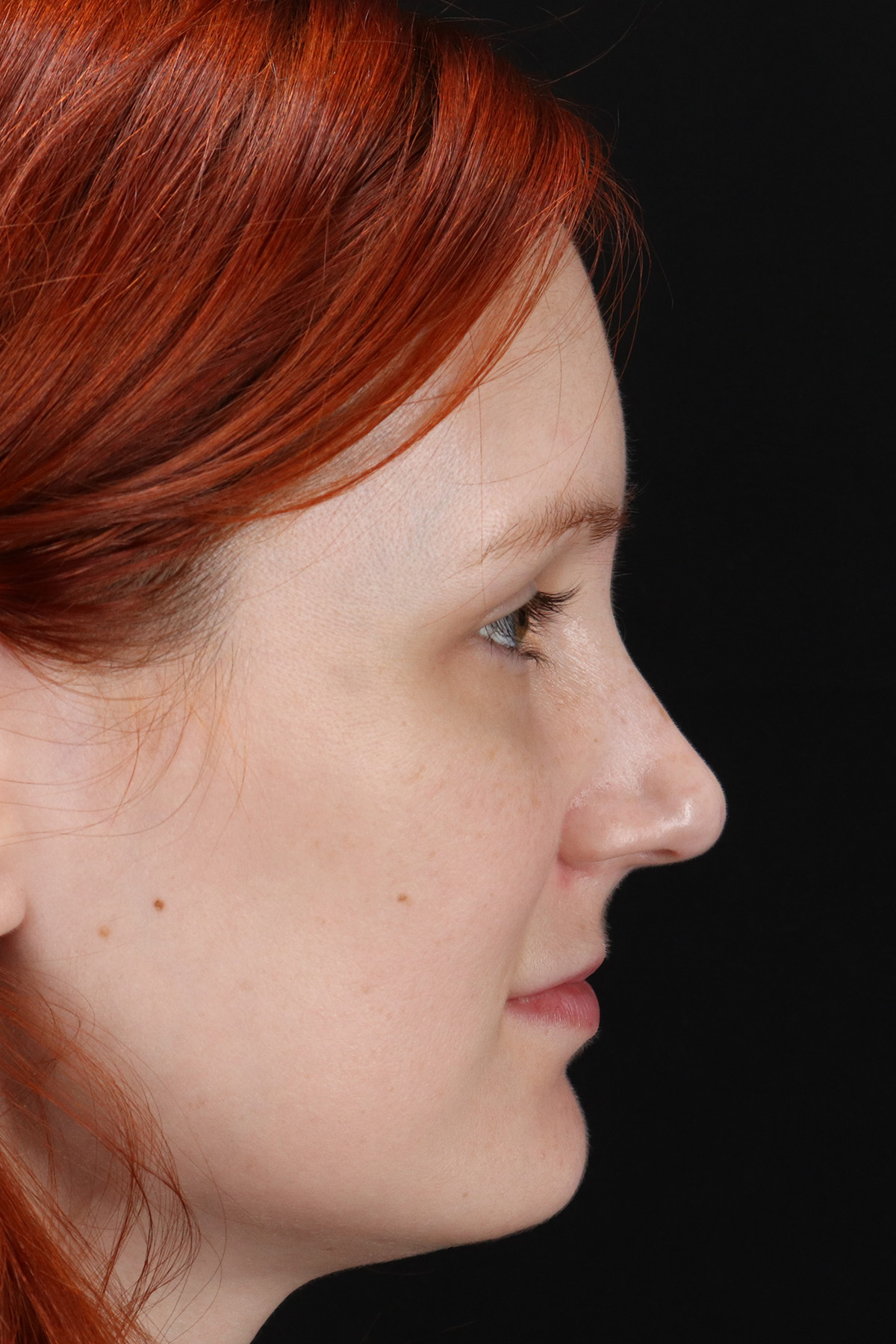 Lower Blepharoplasty Before & After Patient #13008