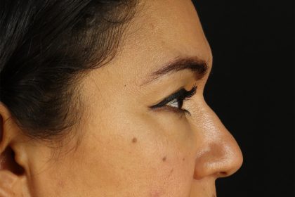 Upper Blepharoplasty Before & After Patient #12007