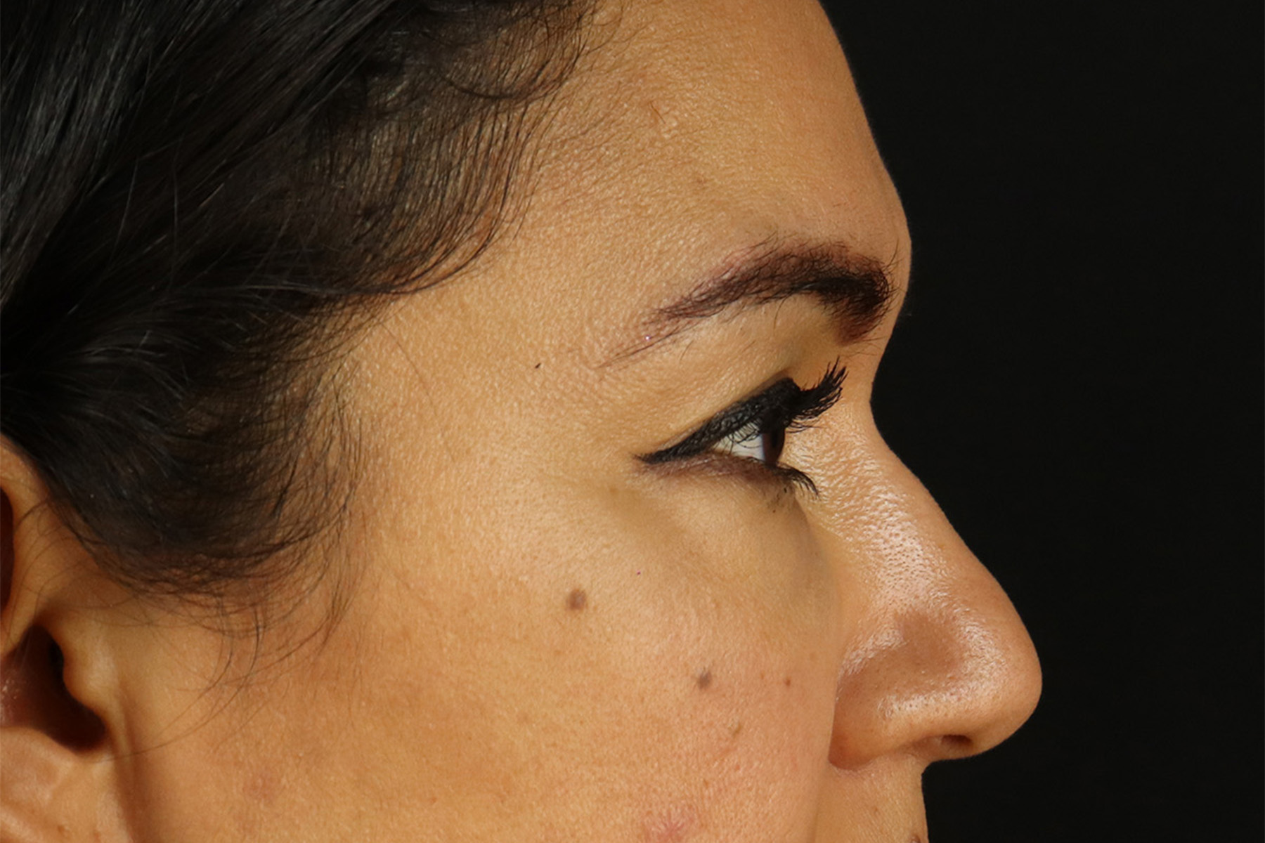 Upper Blepharoplasty Before & After Patient #12007