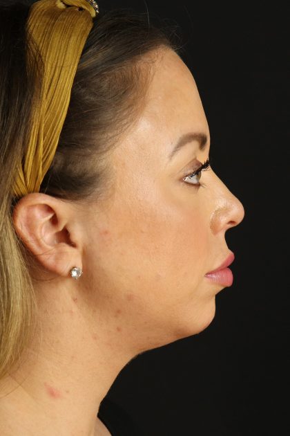 Neck Lift Before & After Patient #12920
