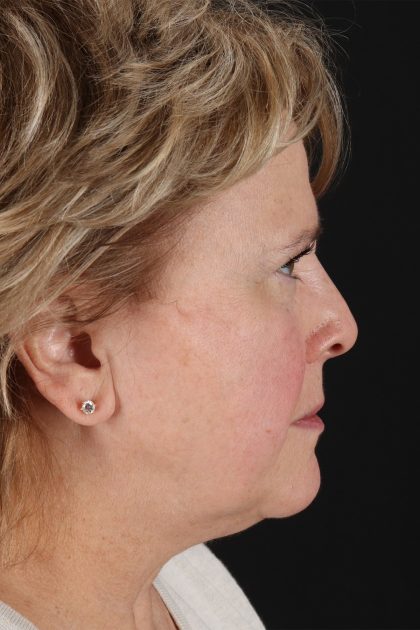 Facelift Before & After Patient #11695