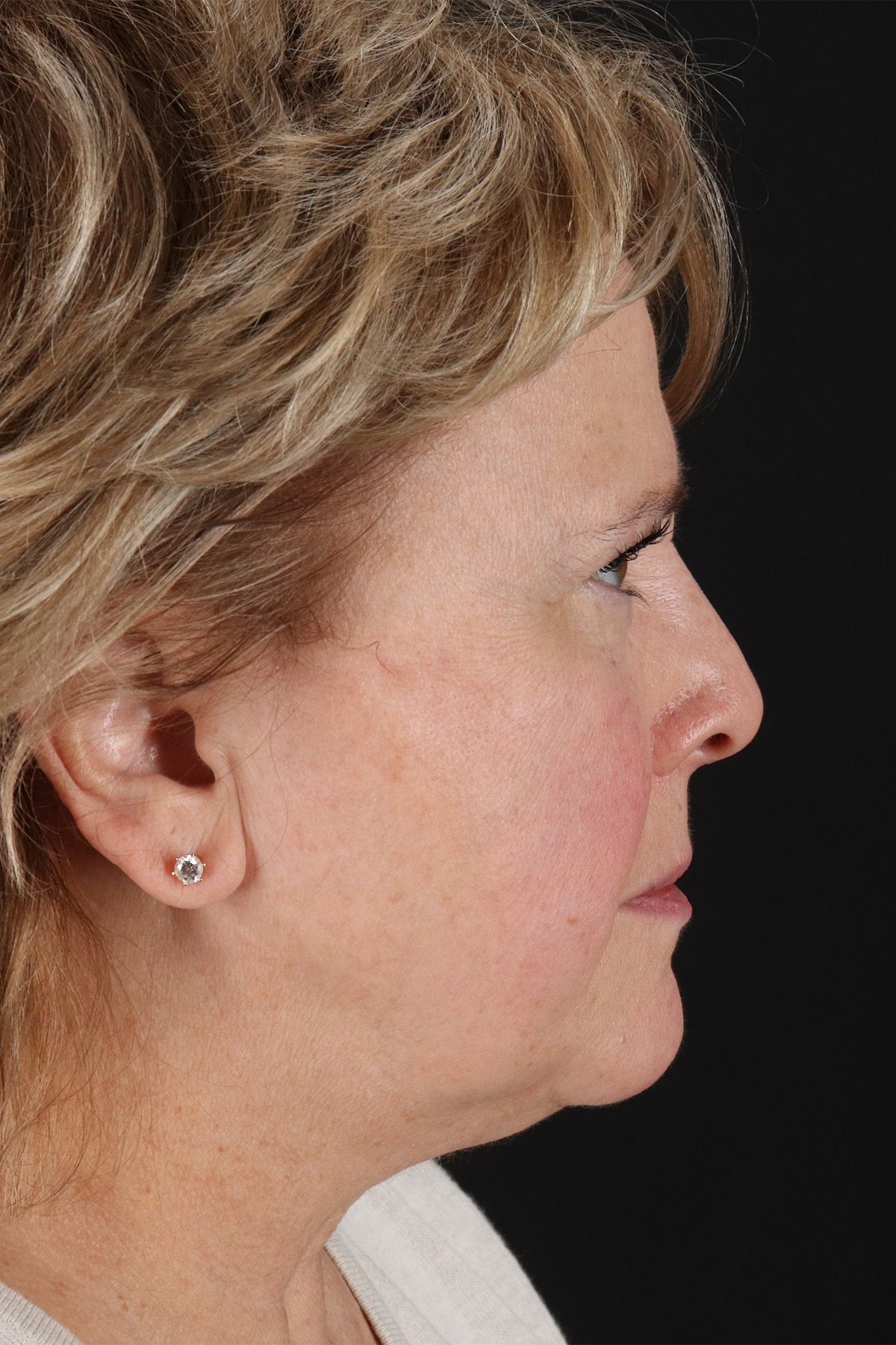 Facelift Before & After Patient #11695