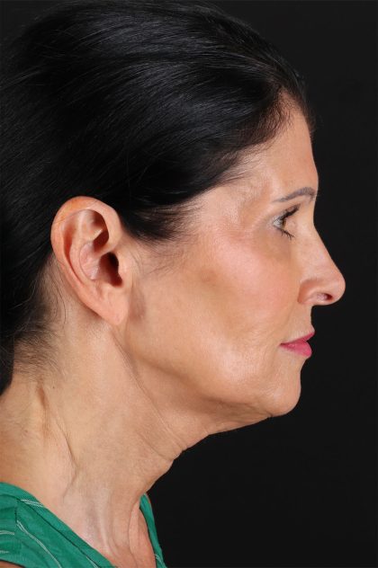Neck Lift Before & After Patient #12887