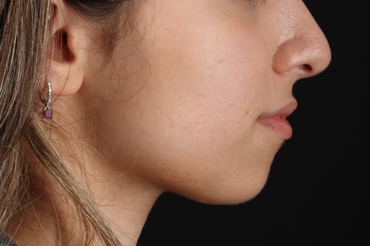 Chin Implant Before & After Patient #13750