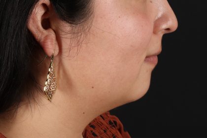 Neck Liposuction Before & After Patient #12106