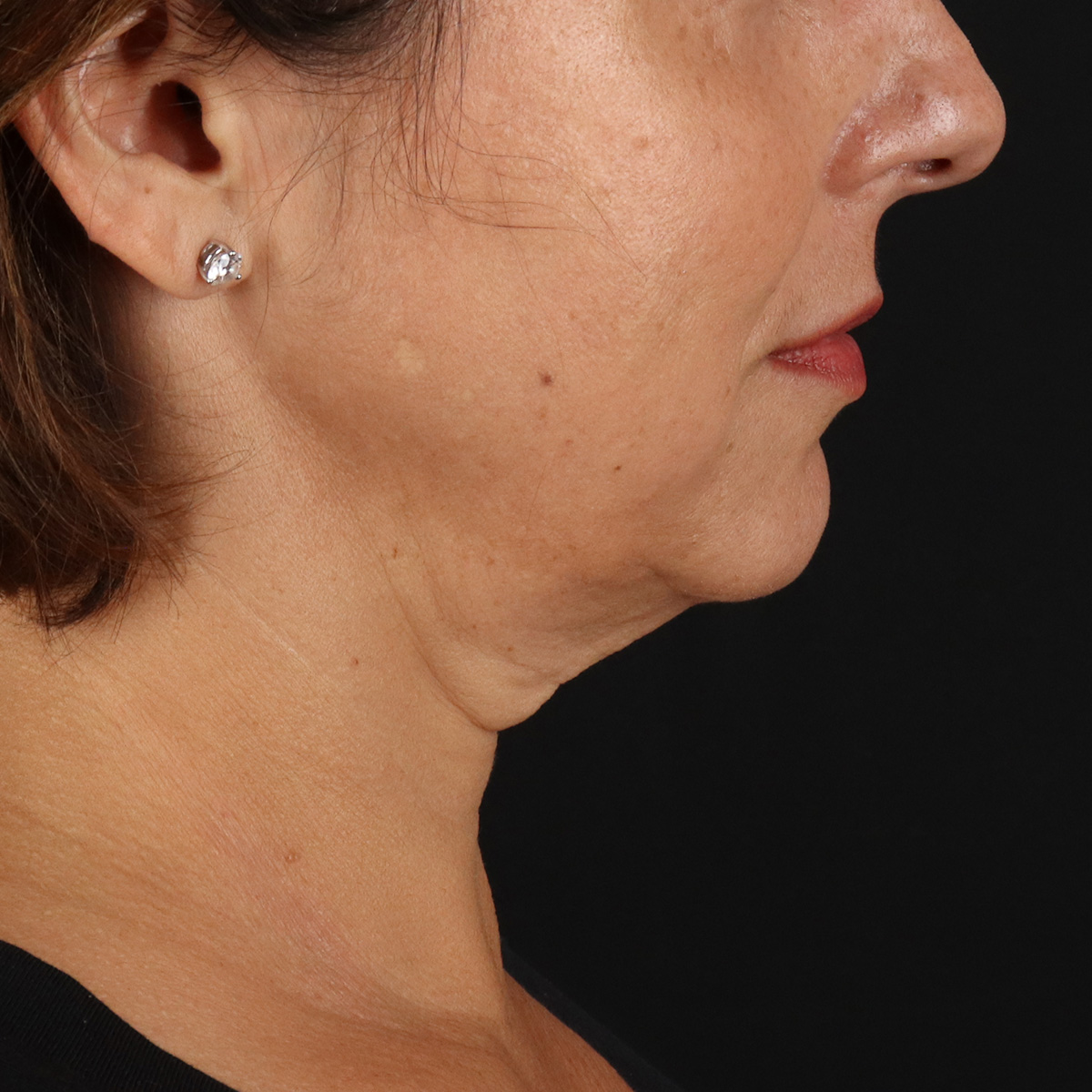 Facelift Before & After Patient #13543