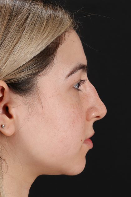 Rhinoplasty Before & After Patient #12271