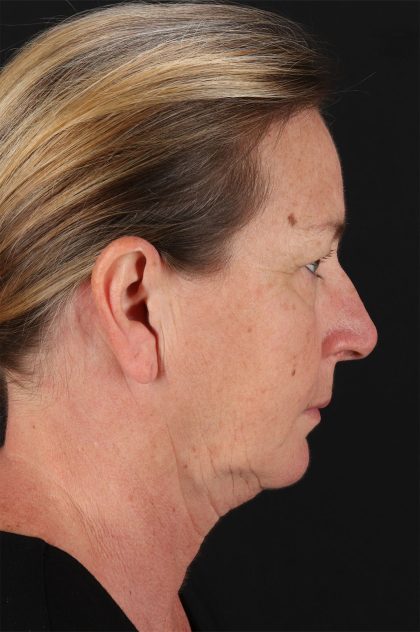 Rhinoplasty Before & After Patient #12315