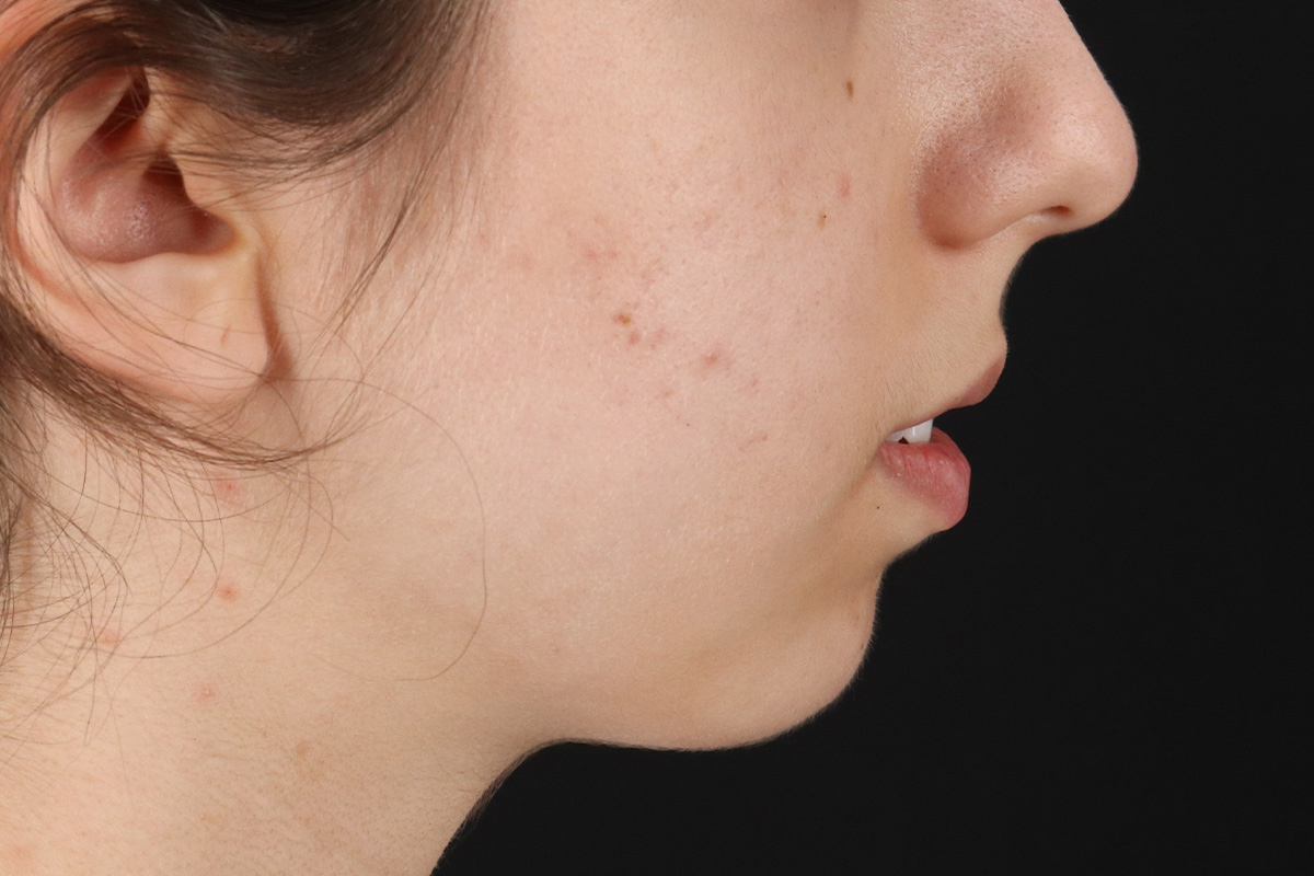 Chin Implant Before & After Patient #13772