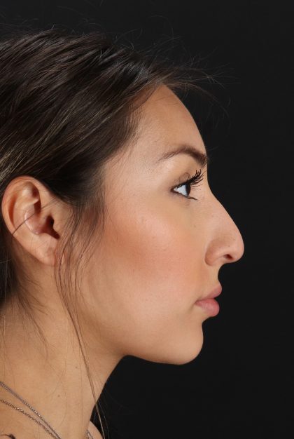 Rhinoplasty Before & After Patient #12480