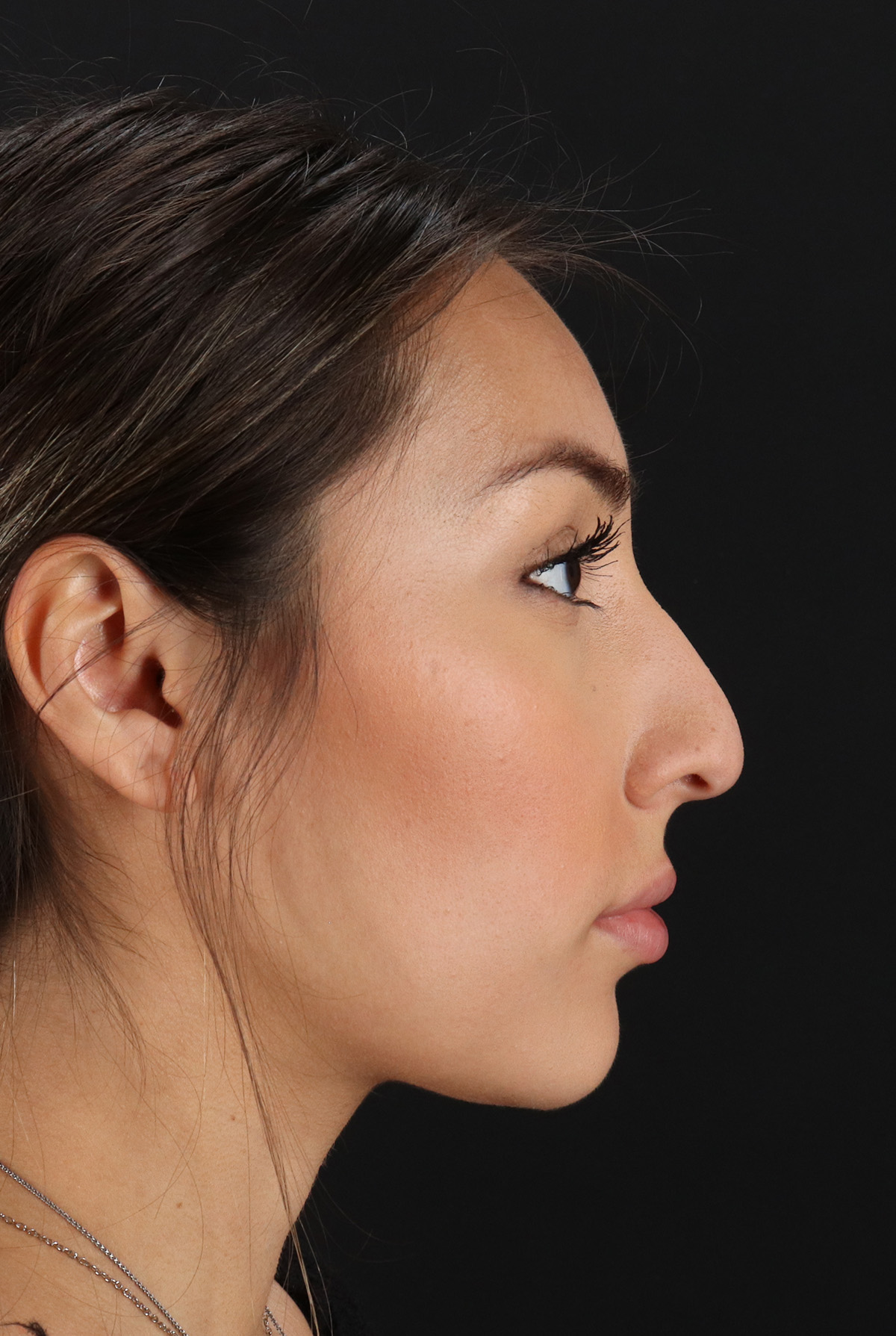 Rhinoplasty Before & After Patient #12480