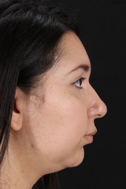 Chin Implant Before & After Patient #13739