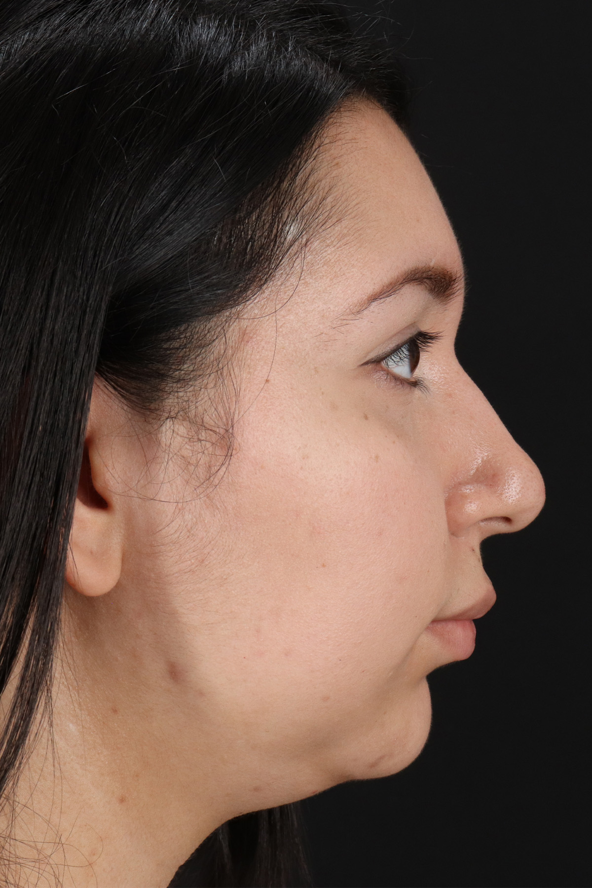 Neck Lift Before & After Patient #11698
