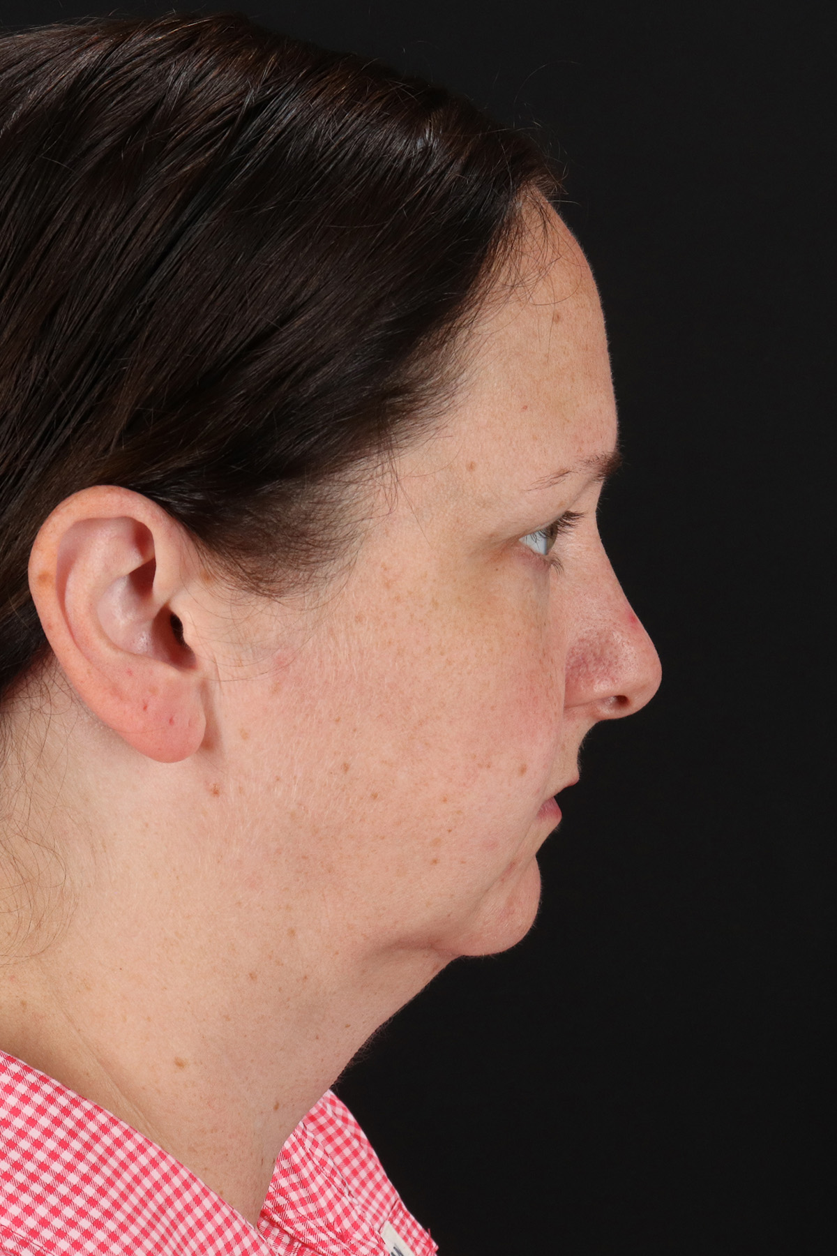 Lower Blepharoplasty Before & After Patient #13052