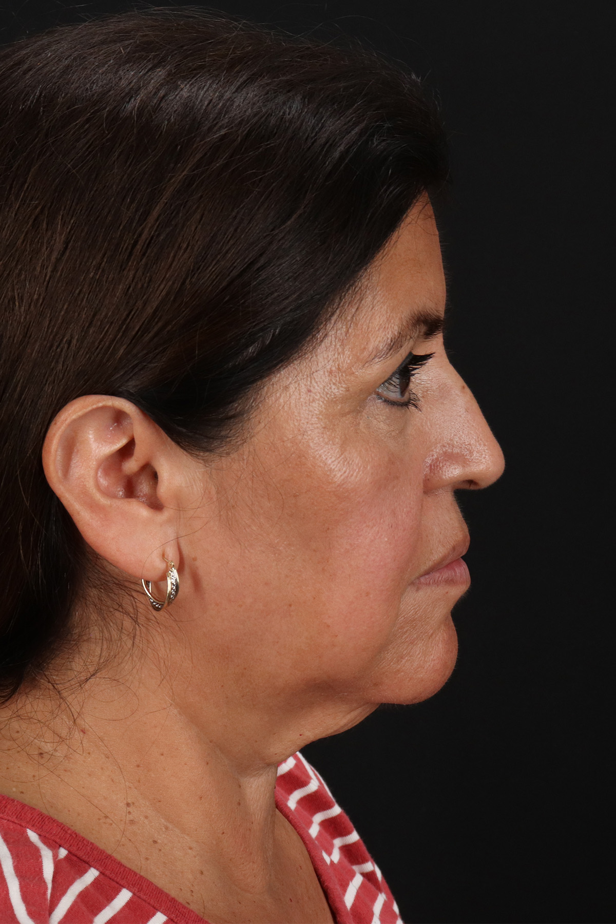 Lower Blepharoplasty Before & After Patient #13063