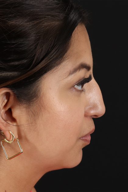 Rhinoplasty Before & After Patient #12458