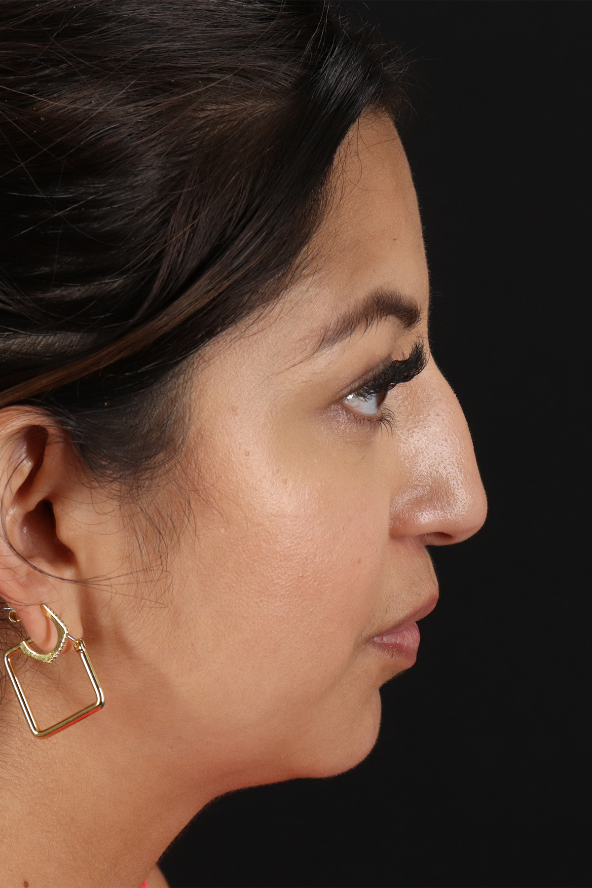 Rhinoplasty Before & After Patient #12458